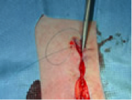 3 point Suture