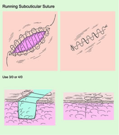 Subcuticular Suture