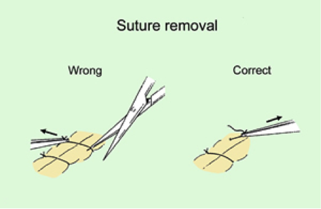 Suture Removal 