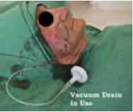 Vacuum Drain